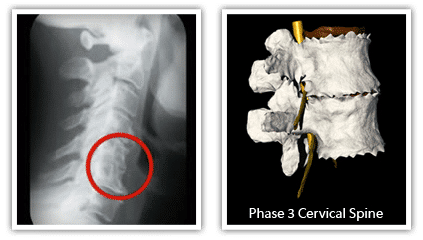 Educational image showing cervical spine degeneration on an X-ray and spine model for a chiropractic care blog post in Goldsboro, NC.
